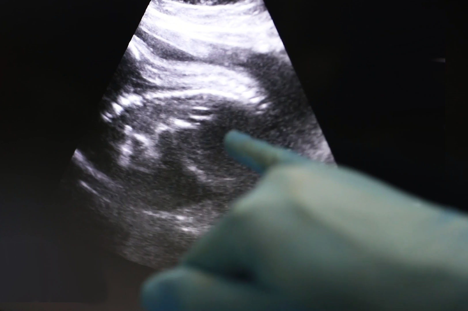 Chirurgia, eccezionale intervento in utero salva feto di 28 settimane