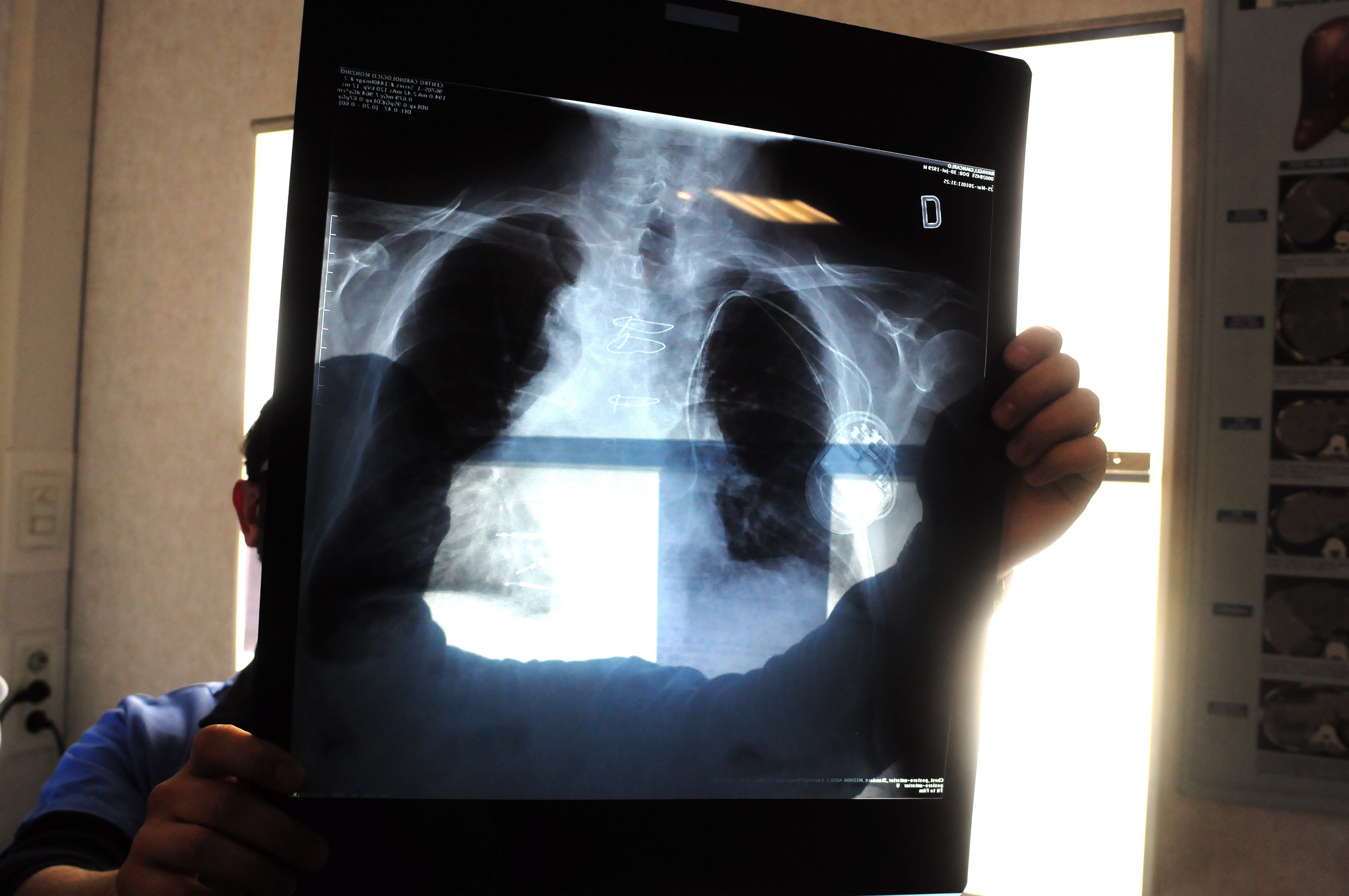 Segni polmonite presenti dopo 6 mesi da Covid, studio in Lombardia