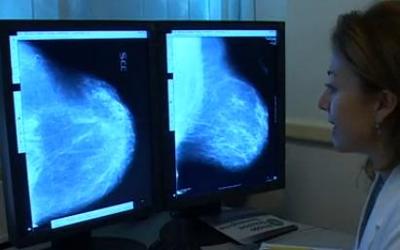 Nuove linee guida internazionali cancro seno, prima firma italiana